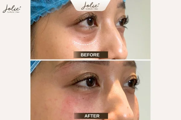 What is dark circles under the eyes?