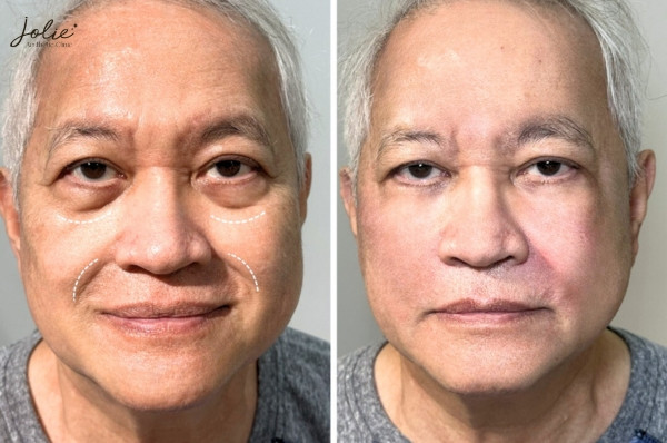 Cost of treating pigmentation in the Philippines, Malaysia, and the UAE