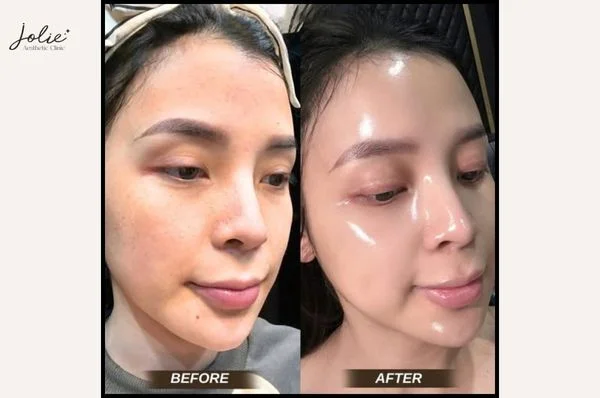 Meso injection is one of the most popular skin rejuvenation methods today