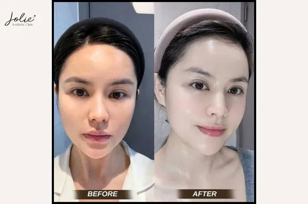Unexpected results before and after Meso Glowing Skin injections