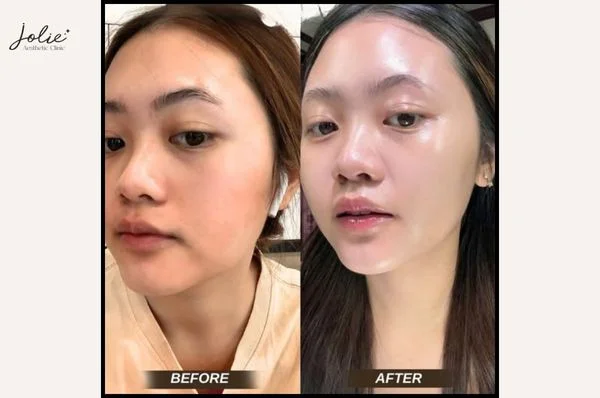 Meso Glowing Skin injections have many benefits for the skin