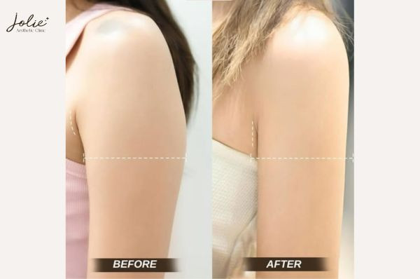 Understanding botox for slimming arm fat