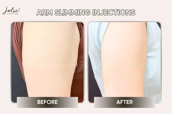 Arm slimming injections give you a slim figure without surgery