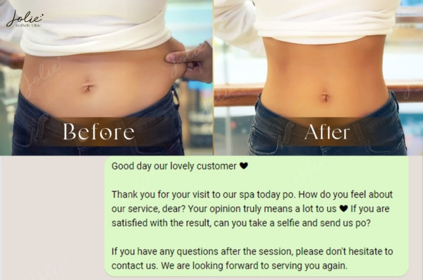 Results after belly fat reduction treatment at Jolie Clinic