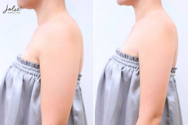 Botox injection method for slimming the arms