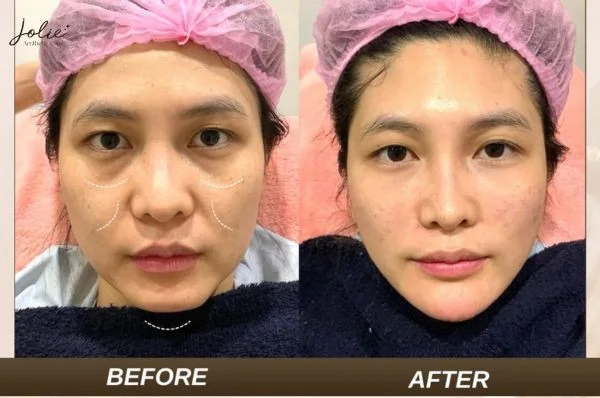 What is the method of HA collagen implantation?