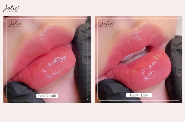 CHEAP LIP FILLER INJECTIONS ADDRESS YOU SHOULD NOT MISS