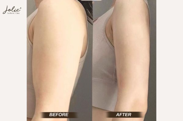 BOTOX SLIMMING ARM FAT FOR GOOD: UNDERSTANDING HOW IT WORKS