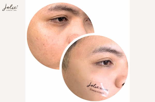 DEEP SCAR TREATMENT AT JOLIE CLINIC: EFFECTIVE, LASTING RESULTS