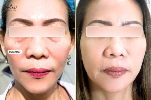 HOW TO FIND THE BEST CHEAP BOTOX INJECTION FOR A YOUTHFUL APPEARANCE