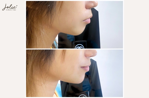 THE BEST CHIN SLIMMING INJECTION FROM A TRUSTED CLINIC: JOLIE CLINIC