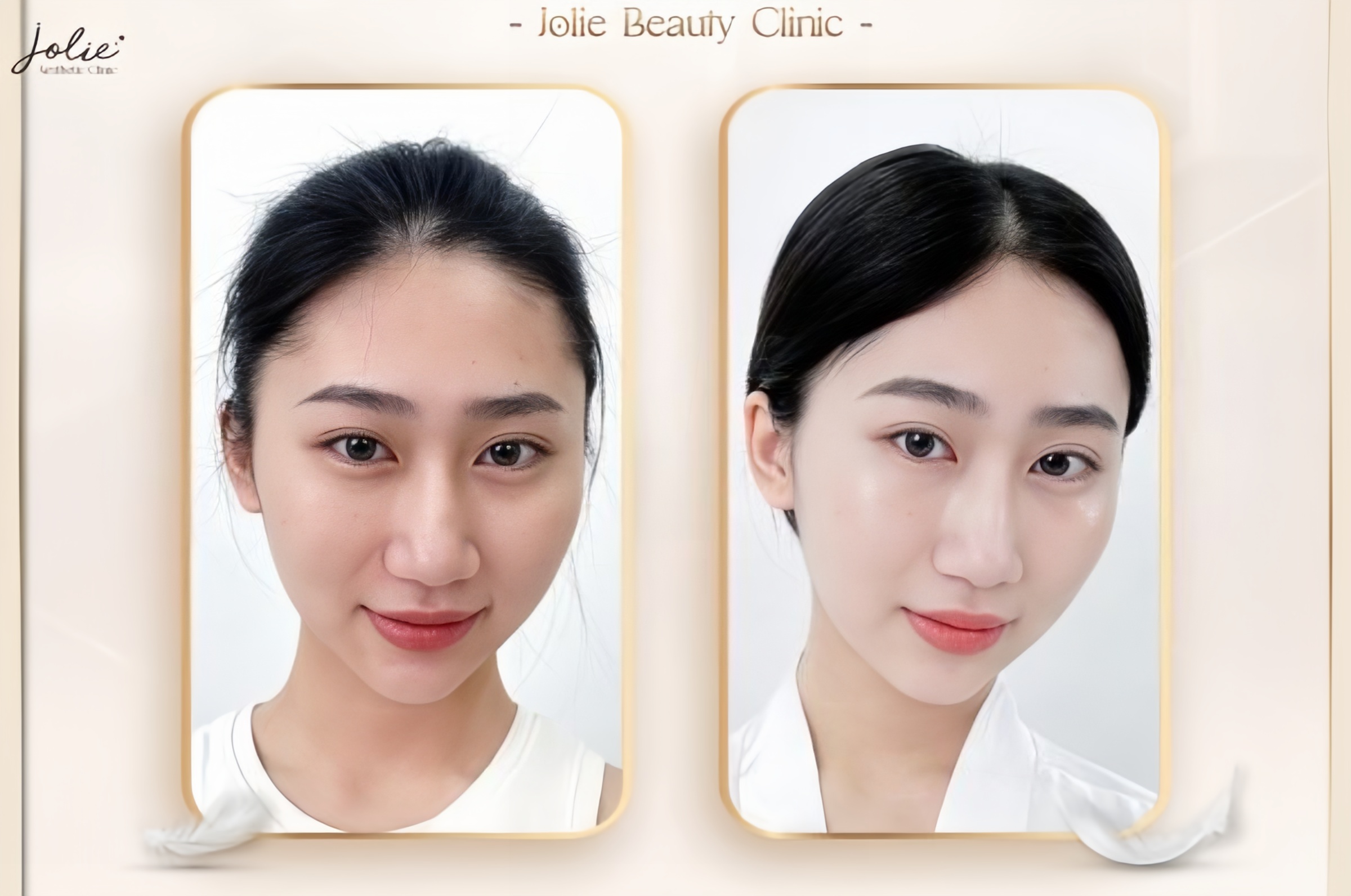 CHOOSE JOLIE CLINIC FOR TOP TRUSTED FILLER INJECTIONS EYES