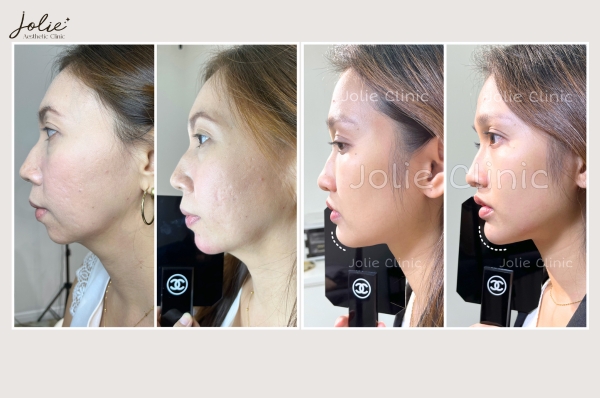 GET A DEFINED AND SAFE JAWLINE WITH CHIN FAT REMOVAL INJECTIONS