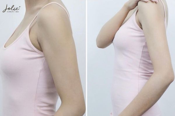 ARM SLIMMING INJECTION: ACHIEVE TONED ARMS IN THE PHILIPPINES